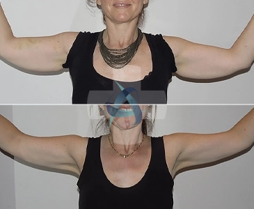 Arm Lift Turkey Before & After