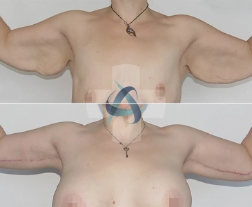 Arm Lift Turkey Experience